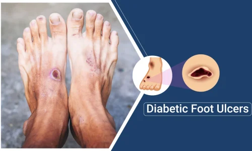 Understanding Diabetic Foot Ulcers: Prevention, Treatment, and Care